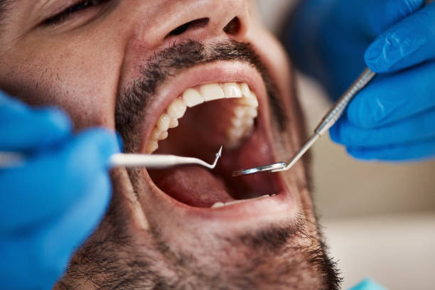 Best Dentist for Tooth Abscess  in Wellman, IA